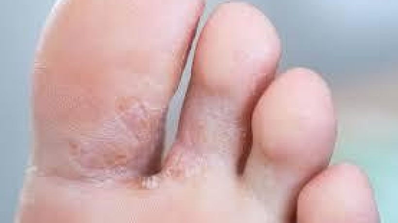 Tips to Help you Care for your Feet in the Summer