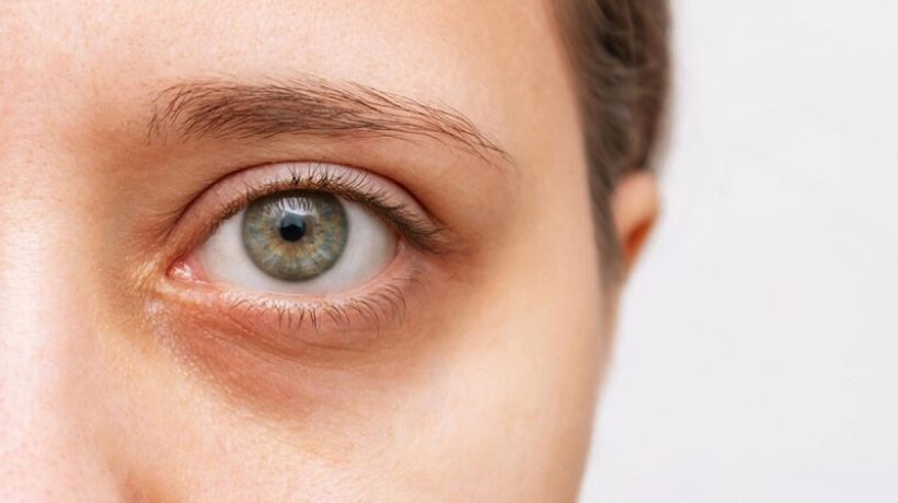 How to remove sunken eyes dark circles