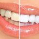 Best non invasive teeth whitening options for sensitive teeth