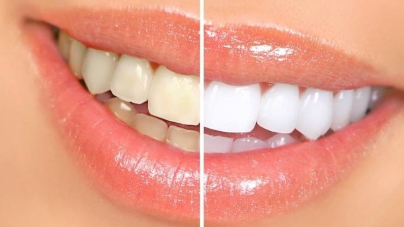 Non-Invasive Teeth Whitening Options for Sensitive Teeth