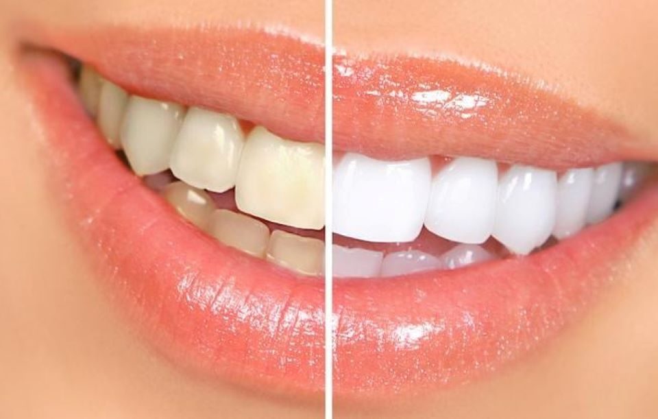 Best non invasive teeth whitening options for sensitive teeth